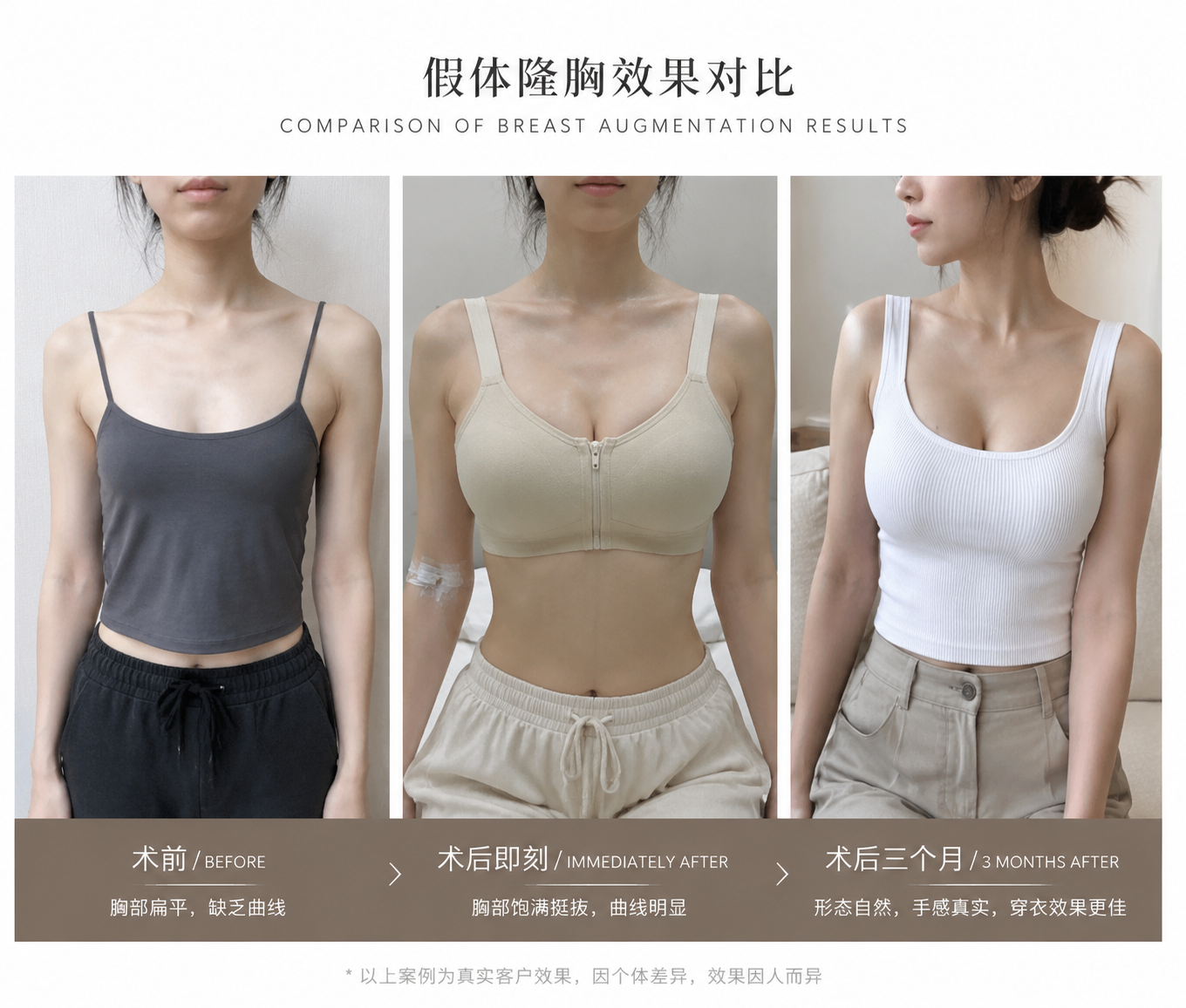 Breast augmentation before, immediately after, and three months post-op comparison